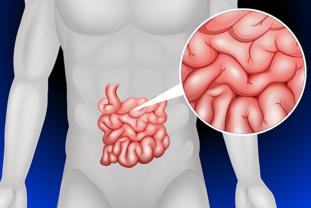 Obstru O Intestinal O Que Causas Sintomas E Tratamentos Cannalize