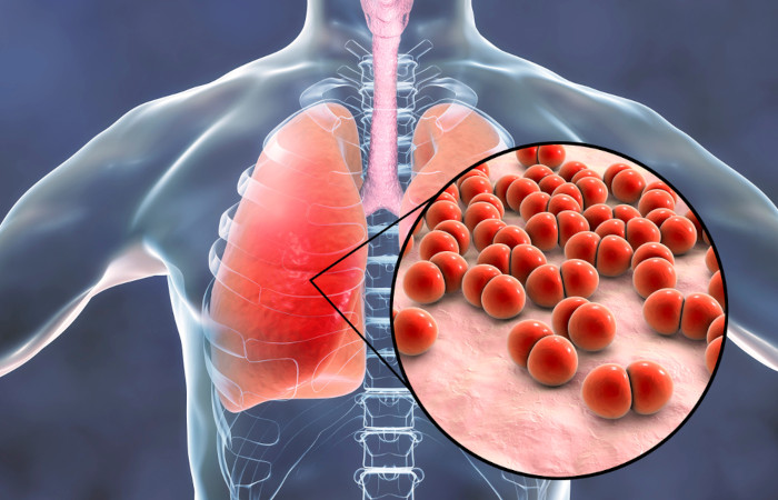 Pneumonia: O que é, Causas, Sintomas e Tratamentos
