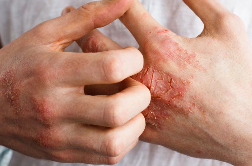  Dermatite Atópica: O que é, Causas, Sintomas e Tratamentos 