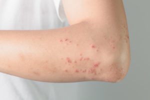 Dermatite Herpetiforme: O Que é, Causa, Sintomas E Tratamentos - Cannalize