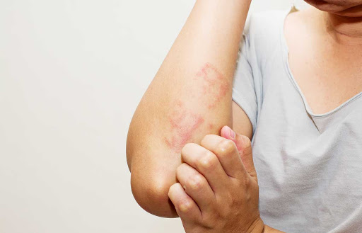  Dermatite Herpetiforme: O que é, Causa, Sintomas e Tratamentos
