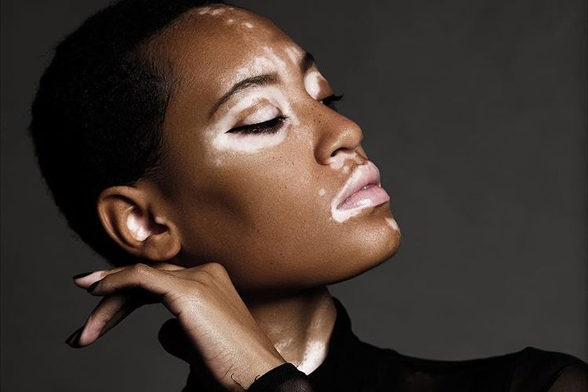 Vitiligo: O que é, Causas, Características e Tratamentos