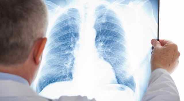 Tuberculose: O que é, Causas, Tipos, Sintomas, Transmissão e Tratamentos