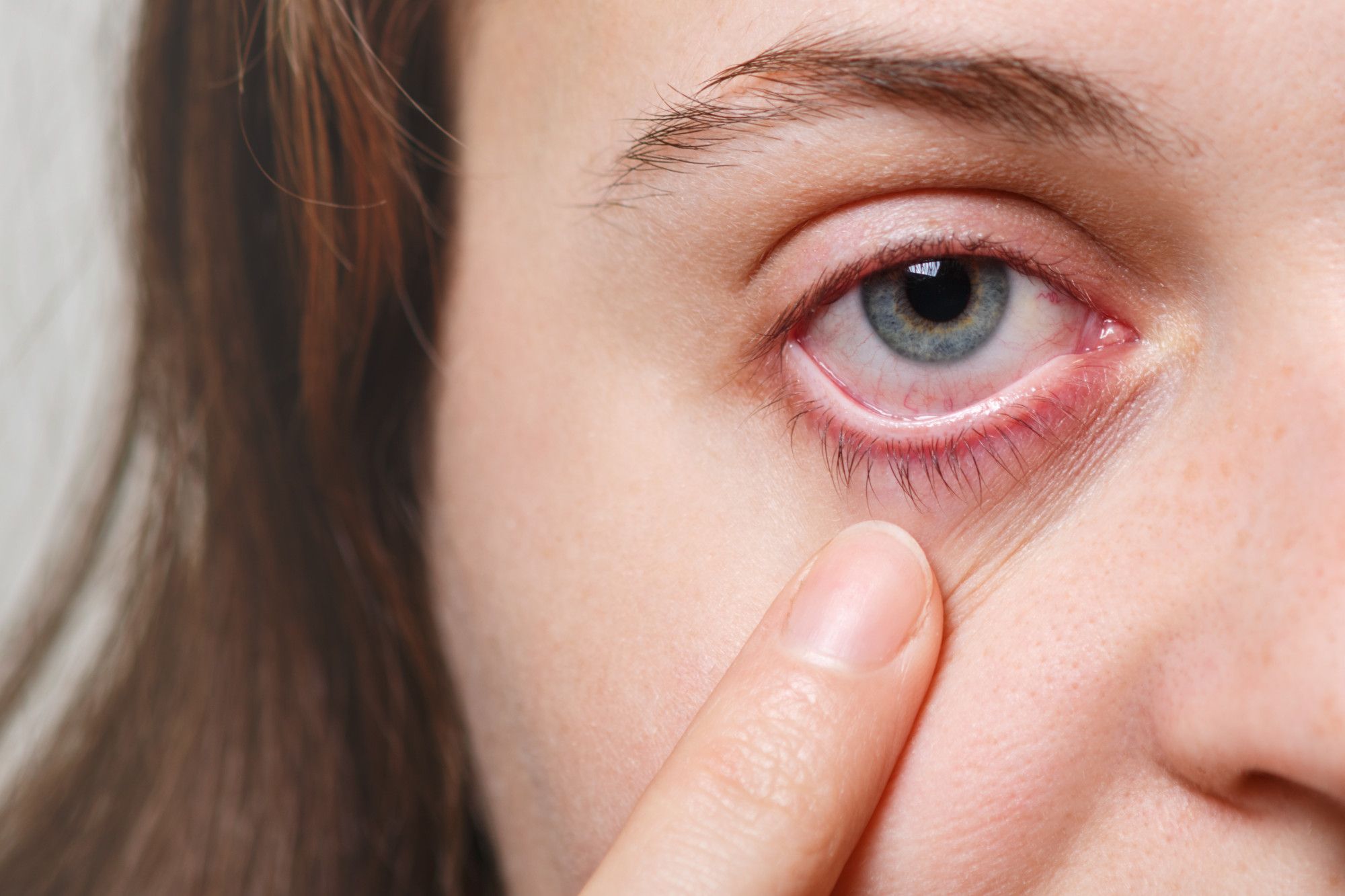 Cannabis para tratar glaucoma: o que se sabe?
