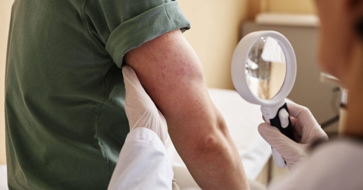 Cannabis medicinal para dermatite: o que se sabe?