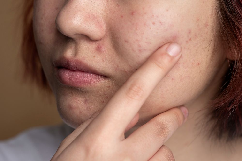 O canabidiol pode tratar a acne?