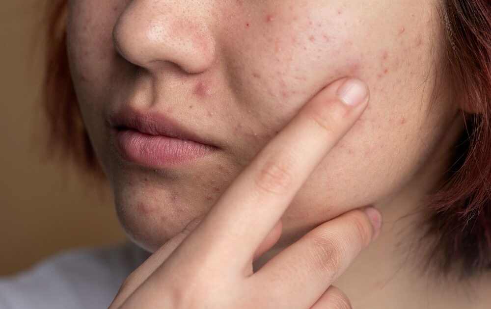 Canabidiol para acne: o que dizem as pesquisas?
